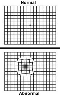 Amsler Grid Test- Retina Ophthalmology Gettysburg PA - Greater Potomac  Retina