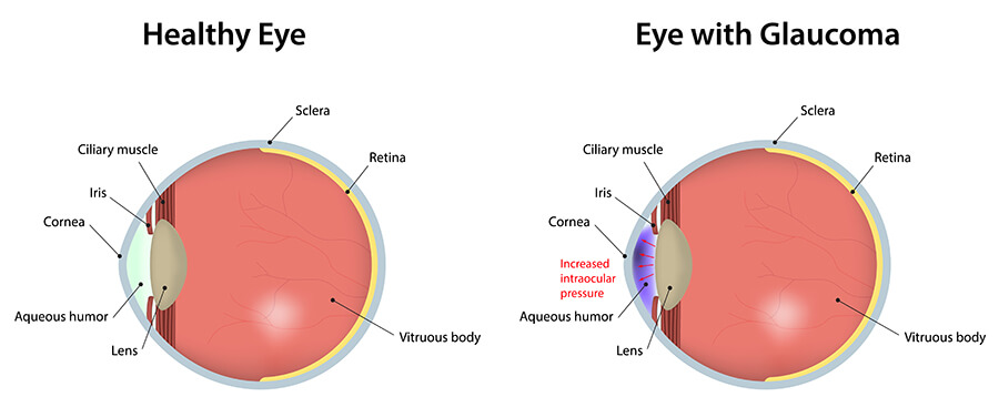 Glaucoma Comparison Diagram